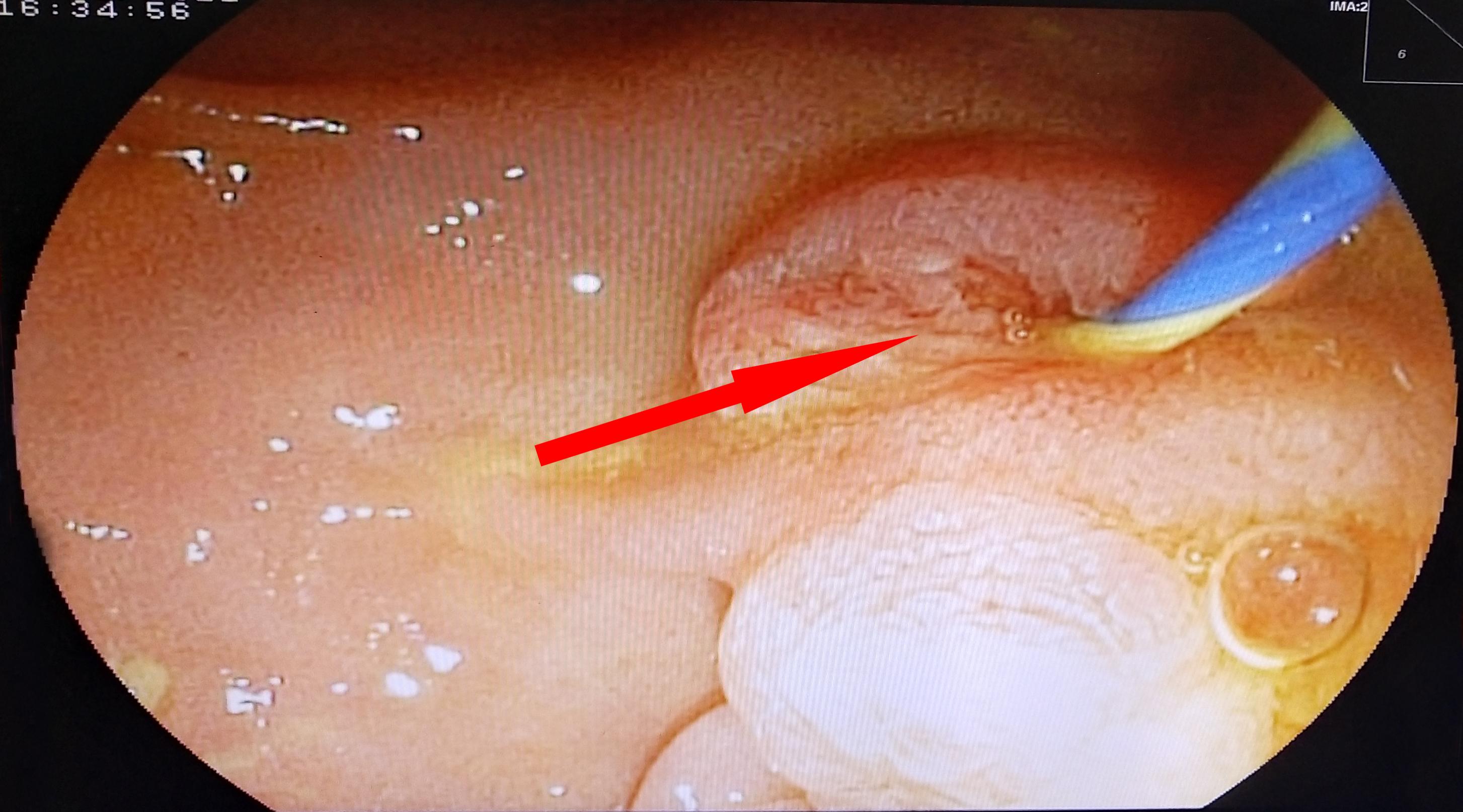 无创切除胆囊,无创取胆囊结石