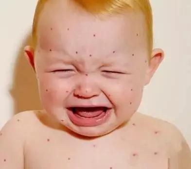 幼儿过敏引起的湿疹用药,宝宝过敏湿疹去同济找哪个医生