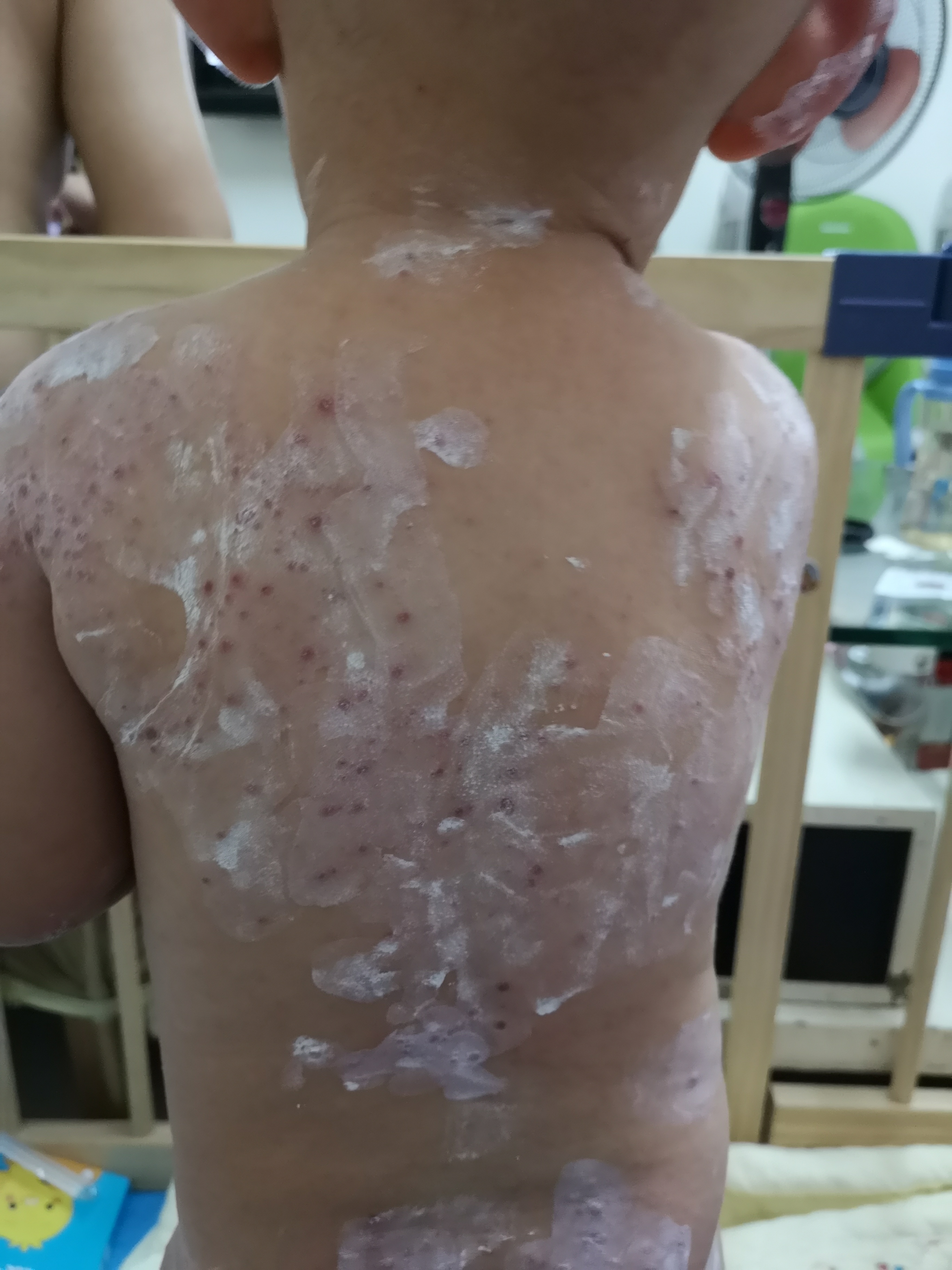 手足口疱疹性咽颊炎进入高发期,手足口高发期孩子有什么症状