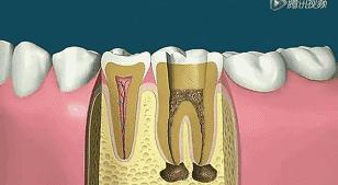 根管治疗第四步骤,根管治疗案例分享话术