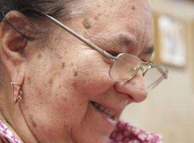 不小心把老年斑弄破了会癌变,老年斑癌变真实案例