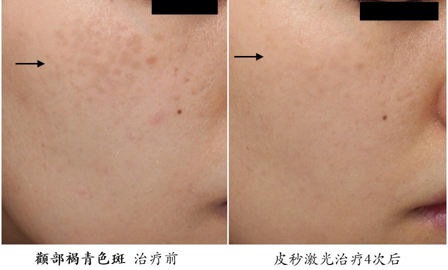 皮秒激光伤皮肤吗,皮秒激光能治凹陷疤痕吗