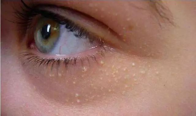 脂肪粒和眼霜有什么关系,眼霜用了长脂肪粒是为什么