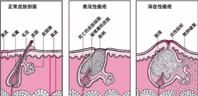 真正有效的祛痘产品,别乱用祛痘产品对症下药才能治痘