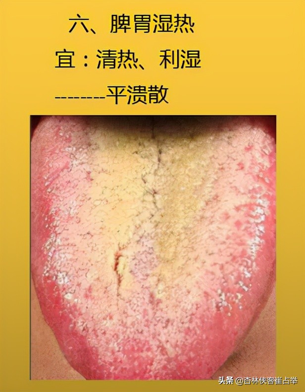 生理性齿痕舌与病理性齿痕舌,齿痕舌形成的原因是脾虚还是瘀血