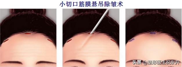 40岁做拉皮手术会年轻几岁,年龄大了做拉皮手术图片