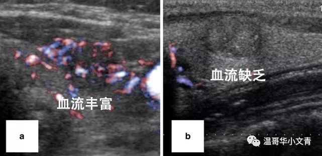 甲状腺结节术后确诊甲状腺癌,甲状腺癌为什么不用ct确诊