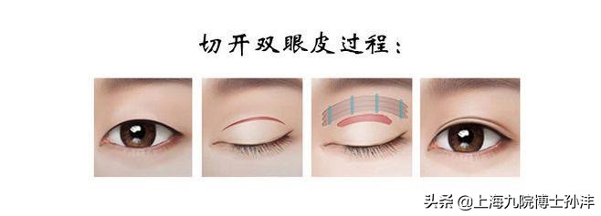 九院博士孙沣：眼部干瘪松弛线条凌乱，其实全切就能很好解决