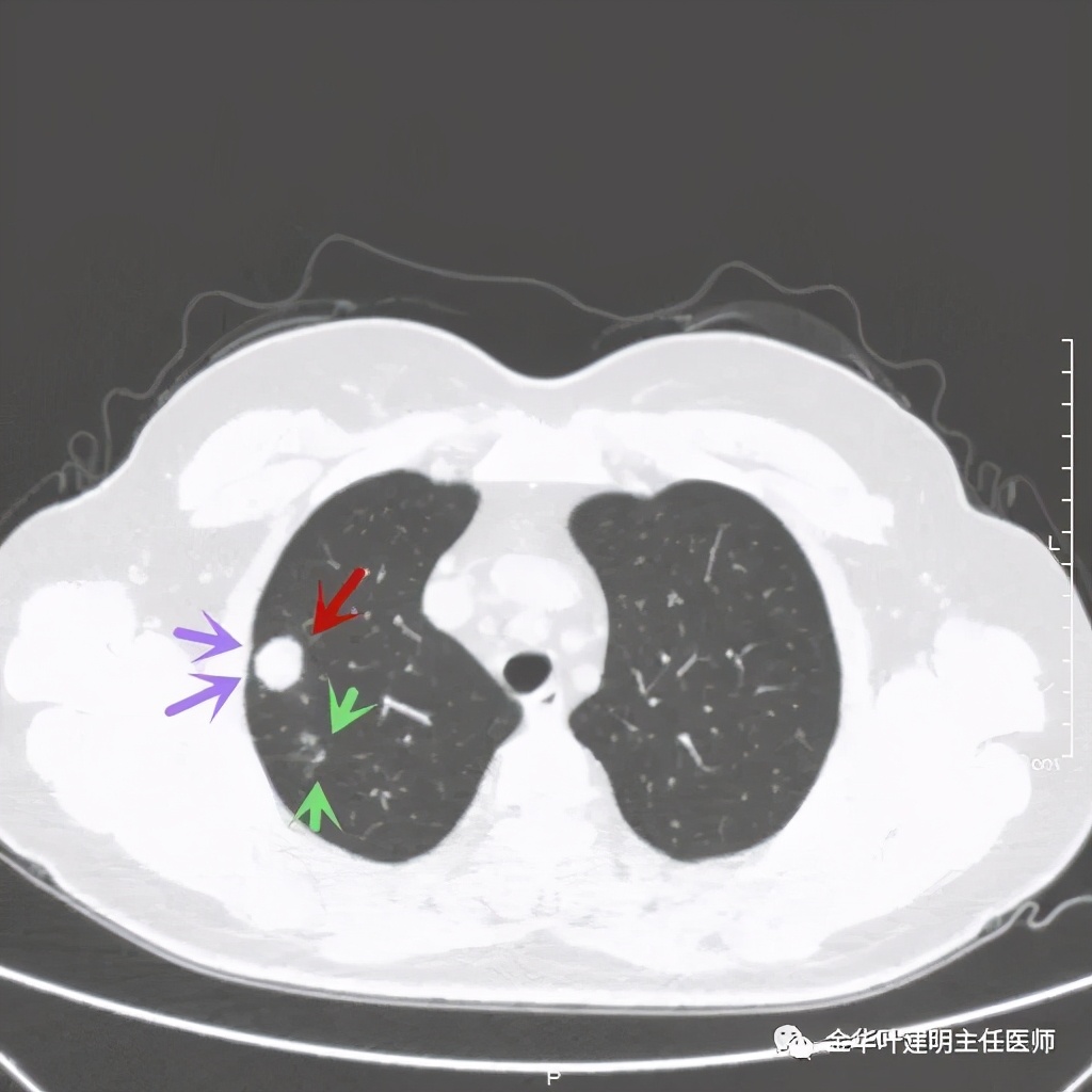 右上肺结节灶一般是什么癌,右上肺恶性肿瘤是肺癌吗