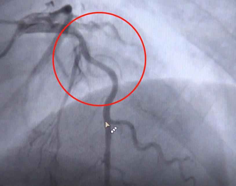 血管狭窄50需要支架吗,血管50%狭窄要长期吃药吗