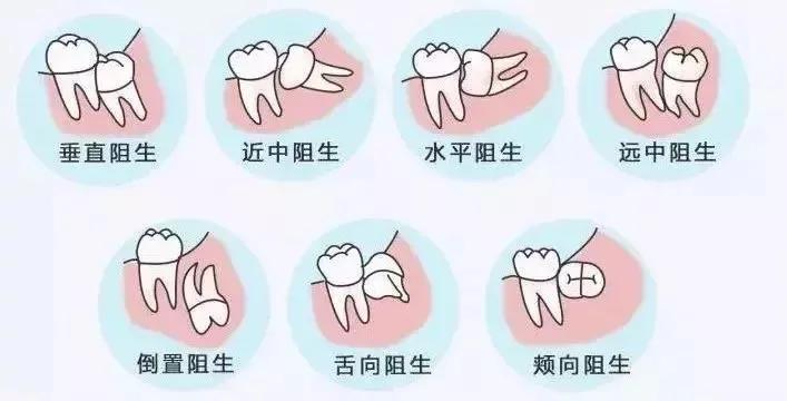 有没有智齿不拔的案例,我有个智齿没长出来怎么拔