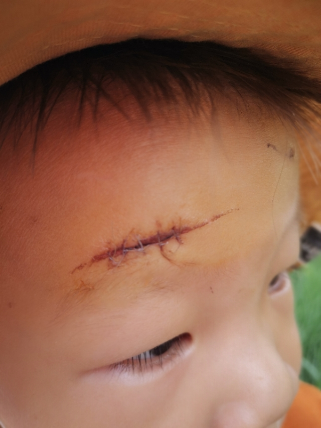 记录一个自责的妈妈，宝宝摔倒缝针，保佑不要留疤