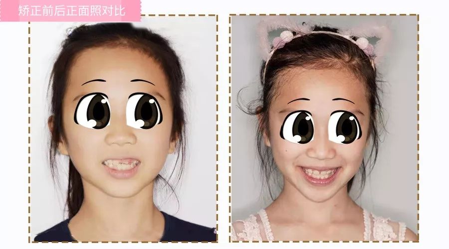 站到台上的“放大镜”女孩，门牙不整齐怎么办？