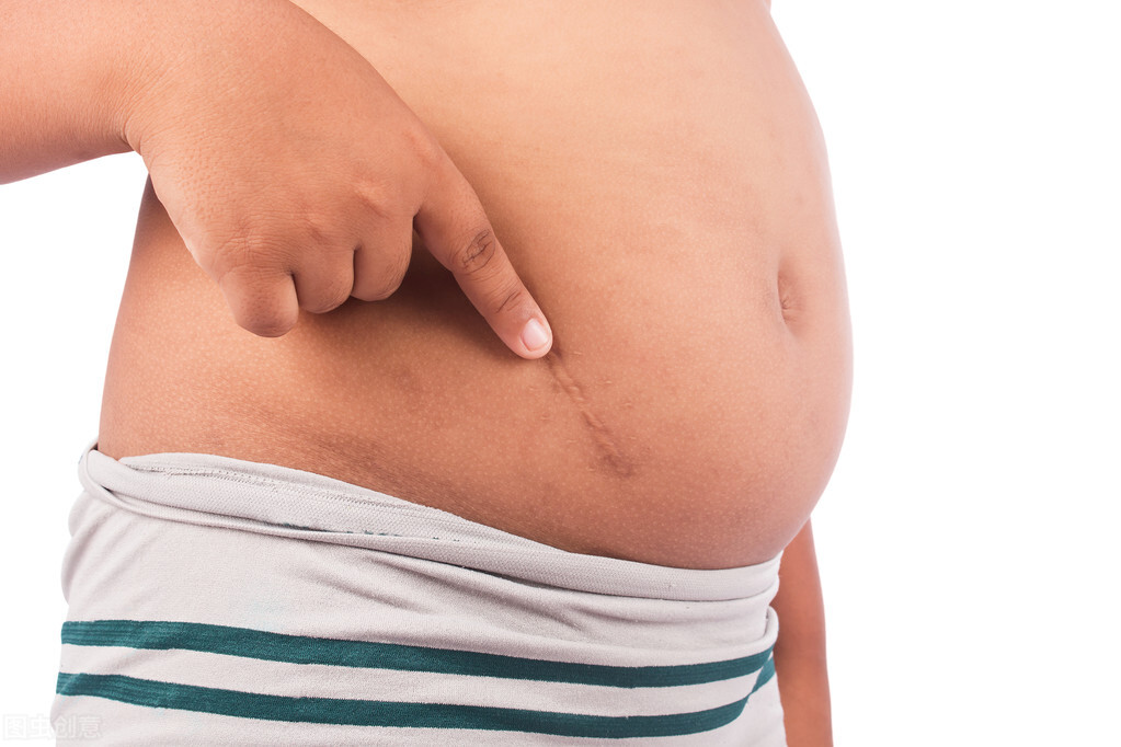 额头缝针疤痕祛除最佳时间,缝针祛疤的最佳时间