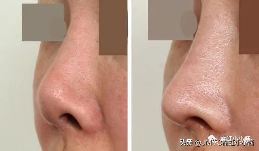 鼻子怎么修复好看呢,鼻型修复方法大全