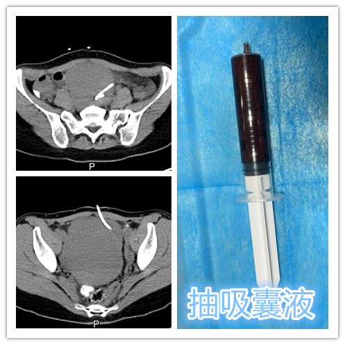 介入栓塞治疗巧克力囊肿,介入超声治巧克力囊肿需要多久