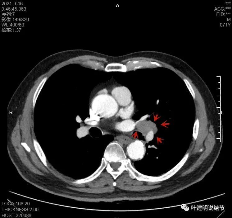 肺上有实性结节6mmx5mm是什么原因,肺上有1.7x1.8的实性结节该怎么办