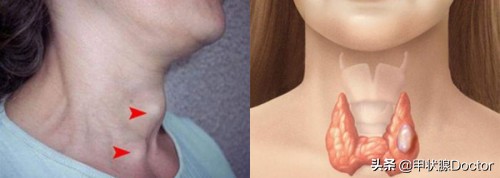 碘131清甲出院后还需要隔离吗,甲状腺癌碘131清甲喝多少剂量