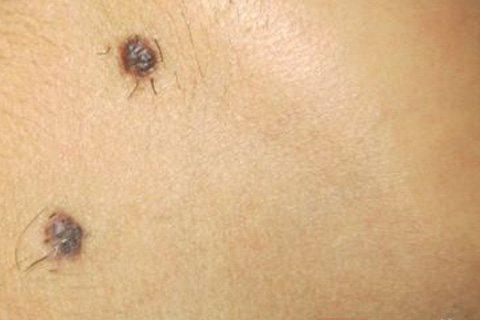 黑痣上长毛是好痣还是坏痣,痣上长毛可以剪掉吗