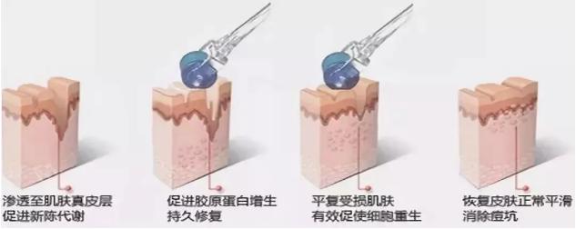 鍋氱編瀹瑰幓姣涘瓟绮夊埡榛戝ご鐥涘悧,鍋氱編瀹圭鐥樺潙
