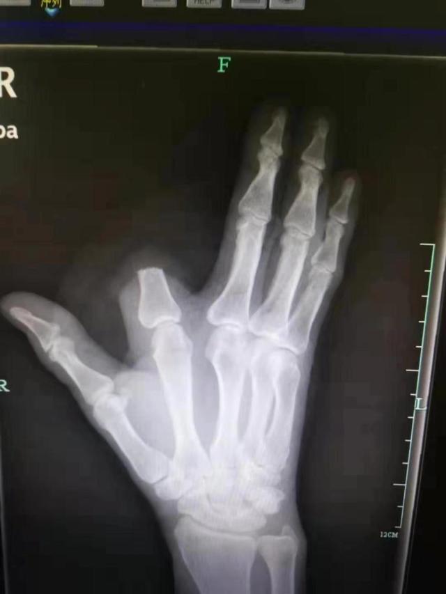 一名男子被蛇咬伤,男子被毒蛇咬伤比毒蛇还毒