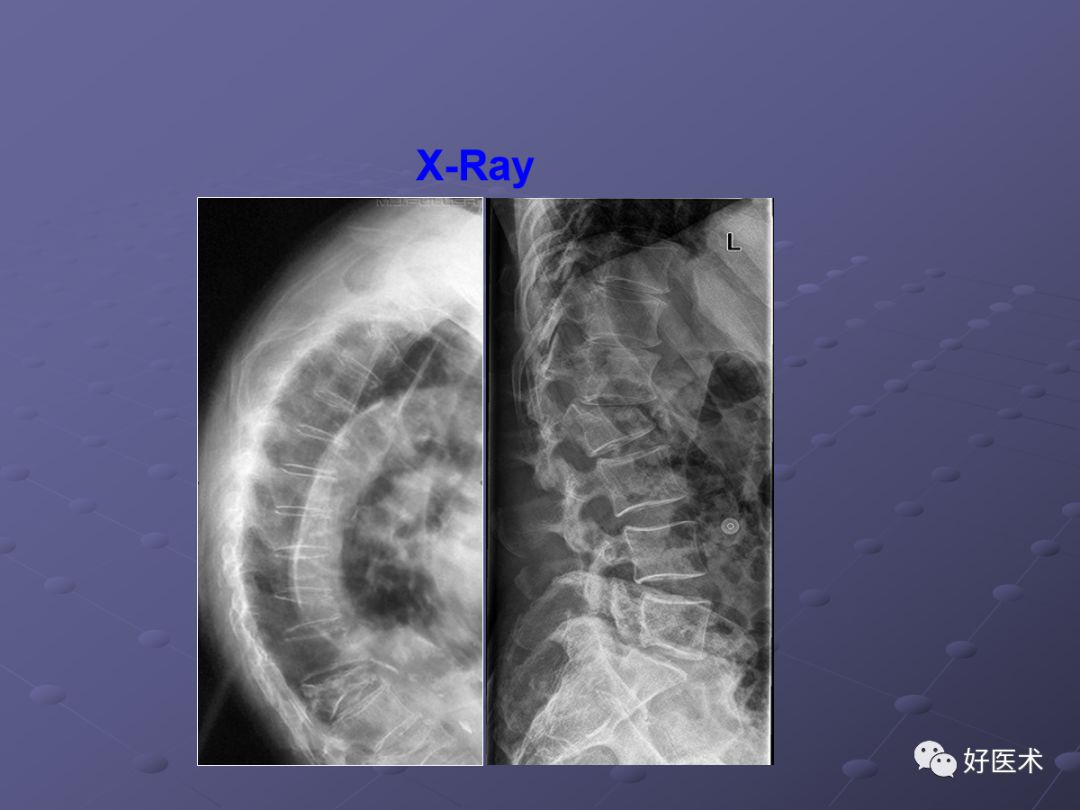 脊柱mri有哪些特点,乳腺疾病的mri诊断及鉴别