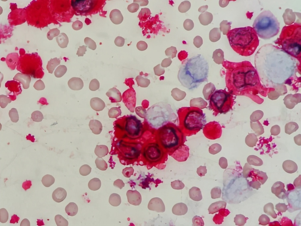 巨大血小板病，主要会导致血小板减少性紫癜，鼻出血等，预后良好