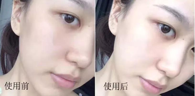 祛痘淡斑美白神器,2毛钱淡斑