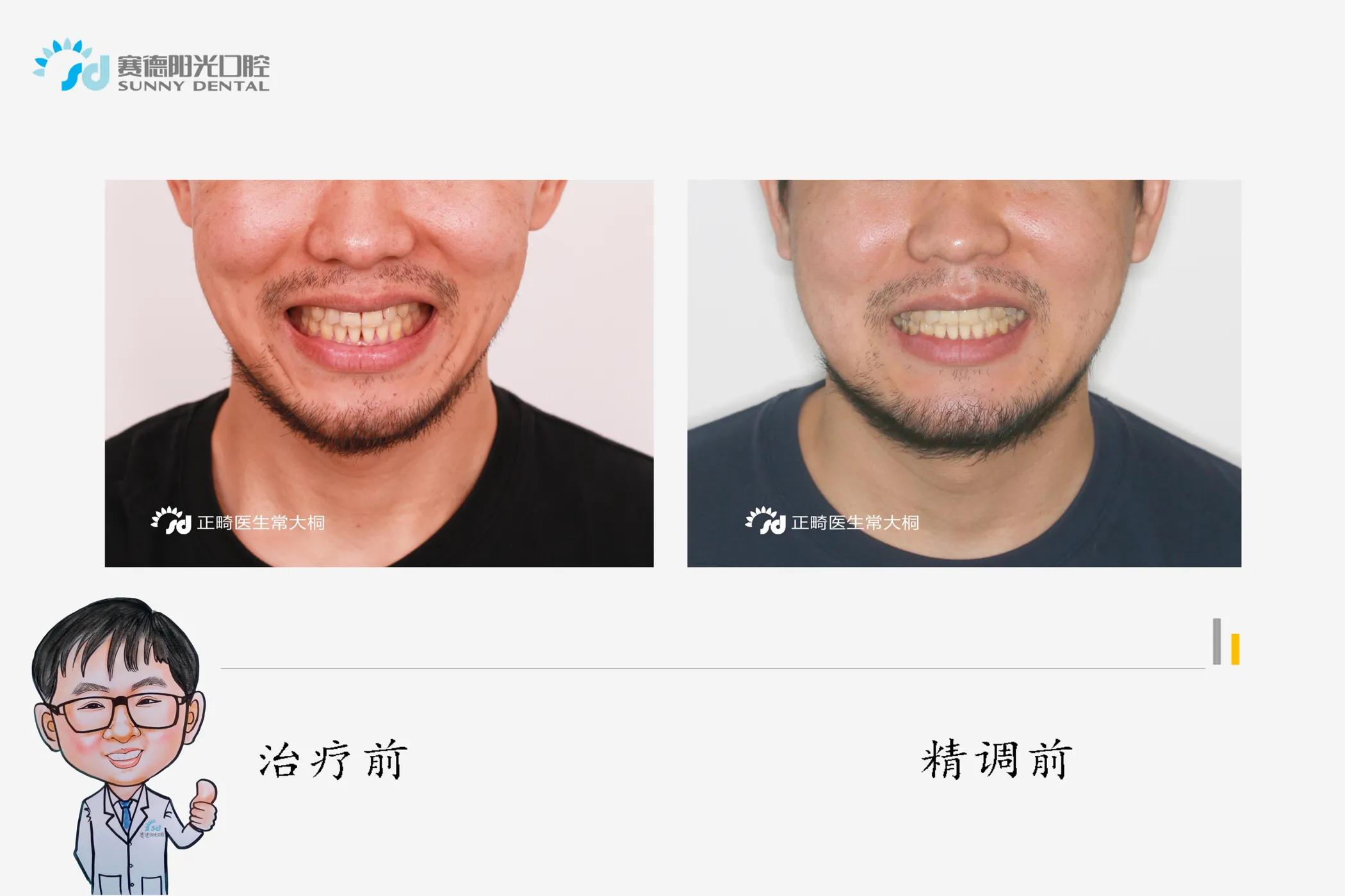 隐适美正畸牙拔掉不美观怎么办,隐适美黑三角什么时候会出现