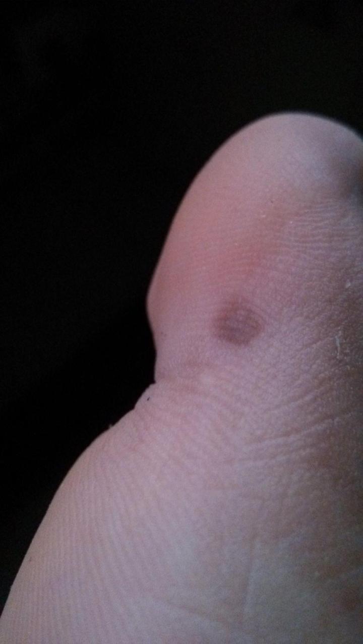 路边摆摊点痣用什么点痣,路边点痣真的可靠吗