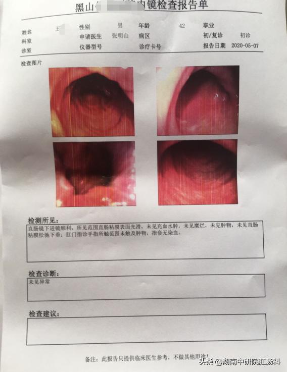 低位直肠癌早期能保肛吗,低位直肠癌晚期治愈吗