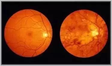 打球撞到眼睛有瘀血怎么快速消,打球被撞伤眼睛视力下降