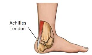 跟腱断裂后期如何保养,运动员跟腱保养方法