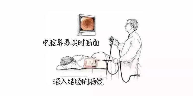 痔疮?便血?你离大肠癌还有多远?