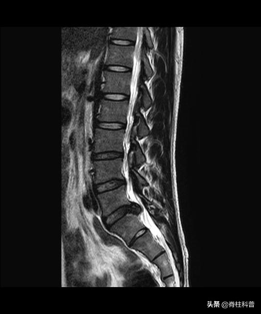 做了腰间盘突出手术复发怎么办,做了腰椎间盘手术复发