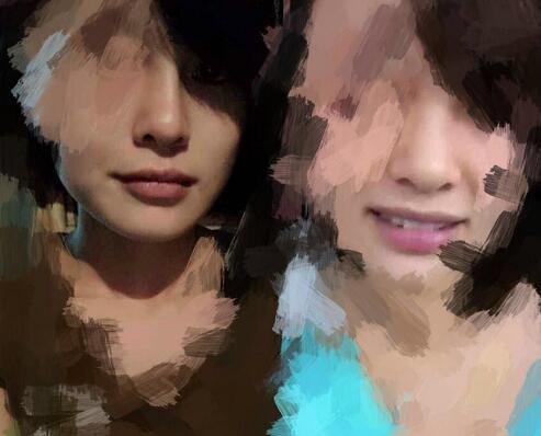 隆鼻手术失败形成的疤痕修复,隆鼻失败后修复还要付费吗