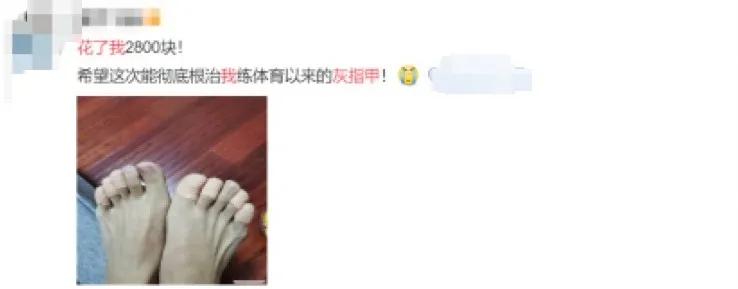 去修脚店治疗灰指甲需要多少钱,灰指甲医院治疗多少钱