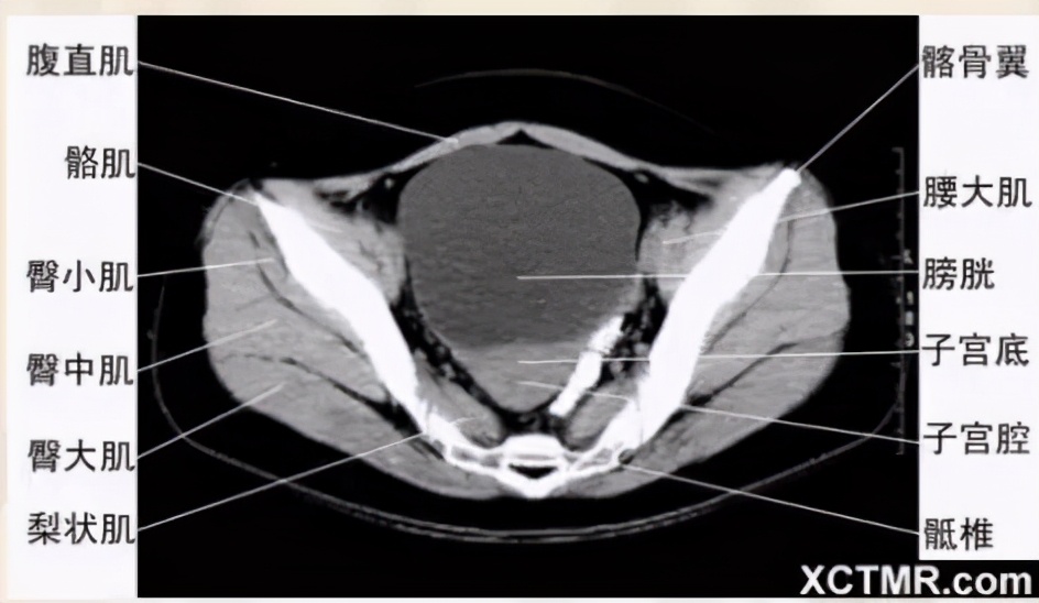 女性盆腔ct断层解剖结构图,女性盆腔脏器ct解剖