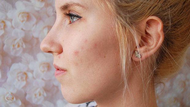 祛痘印不刺激药膏,祛痘印精华不用避光使用