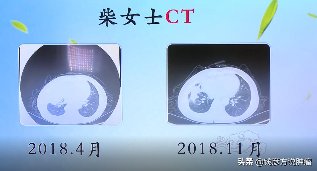 蜈蚣蝎子治疗肺癌的真实案例,全蝎治疗癌症药方