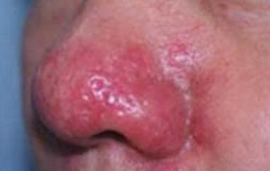 这令人烦心的酒糟鼻到底该如何应对？