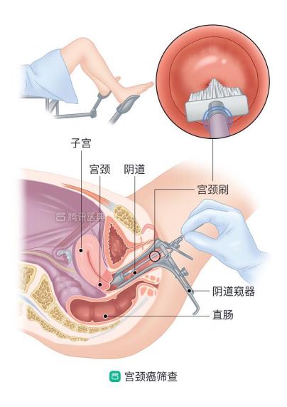 女宫颈癌预防疫苗,宫颈癌怎么预防和筛查