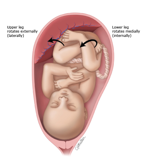 小孩子走路内八字要不要干预,婴儿走路内八字需要治疗吗