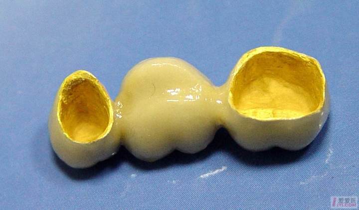 牙冠的常见种类与区别,牙冠什么种类性价比高