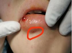 唇部肿胀原因,唇部刺痛红肿是怎么了