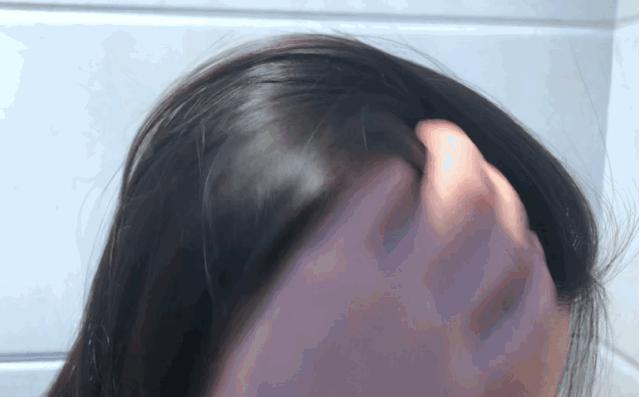 头发毛躁并且脱发推荐洗发水,用什么洗发水改善头皮脱发