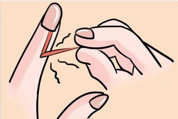 如何判断手上水泡是手癣还是疱疹,忍不住撕手指上的皮