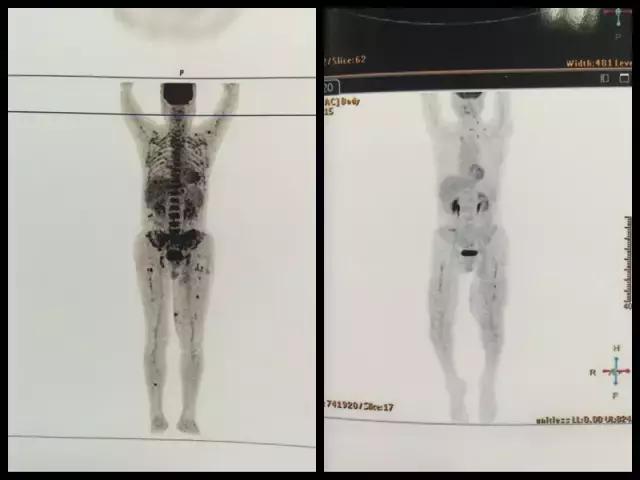 这些癌变信号别大意,这些癌前病变千万别忽略