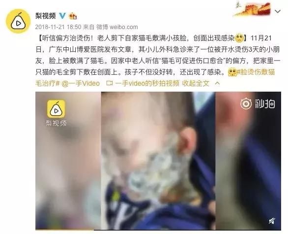 儿童烫伤第一时间的正确处理方法,儿童烫伤急救处理方法