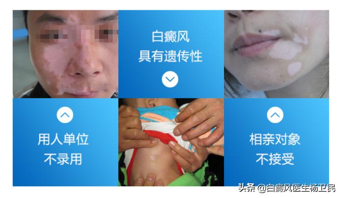 哪些误区阻挡你的白斑消除,白斑的真正可怕之处
